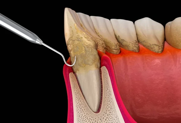 3D dental cross-section illustration showing a metal dental scaler tool clearing heavy calculus buildup from the root of a tooth beneath inflamed gum tissue during periodontal root planing therapy.