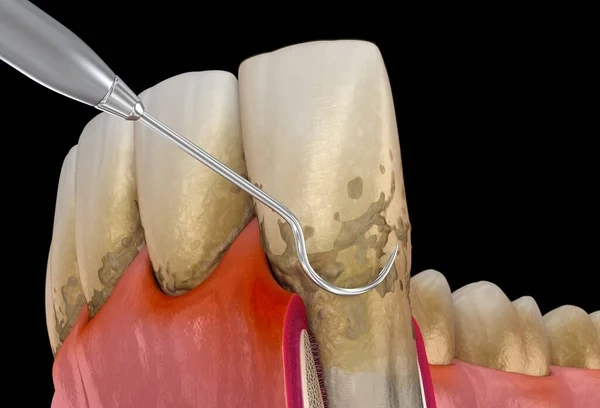 3D dental illustration showing a metal periodontal curette tool removing calculus and plaque deposits below the gumline during a deep cleaning scaling and root planing procedure.