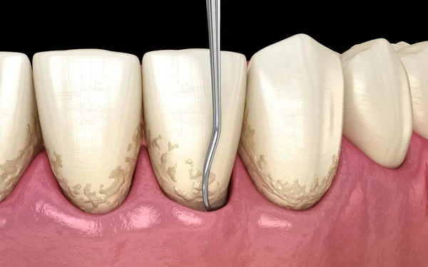 3D dental illustration showing a metal periodontal probe or scaler inserting between teeth with mild calculus deposits at the gumline to demonstrate a scaling and root planing treatment.