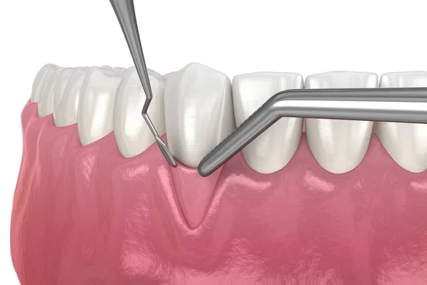 3D dental illustration showing a soft tissue graft surgery procedure with a scalpel or dental instrument precisely preparing the exposed root area of a recessed lower front tooth.