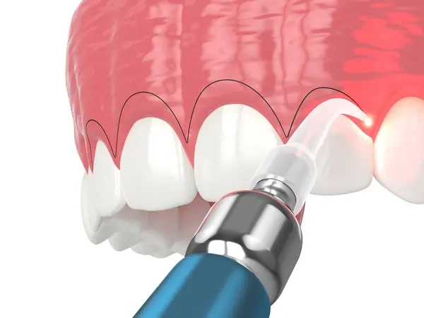 3D dental model showing a cosmetic laser removing excess tissue during a gummy smile gingivectomy procedure