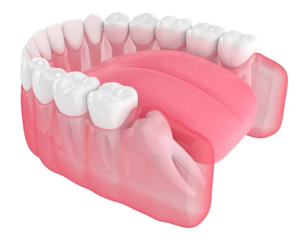 3D dental render of a lower jaw model showing a mesial wisdom tooth impaction growing sideways into an adjacent molar