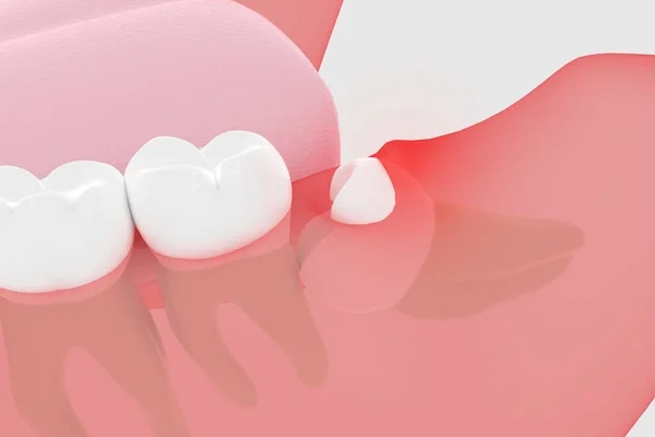 3D dental render showing a partially erupted wisdom tooth trapped beneath the gum line of the lower jaw.