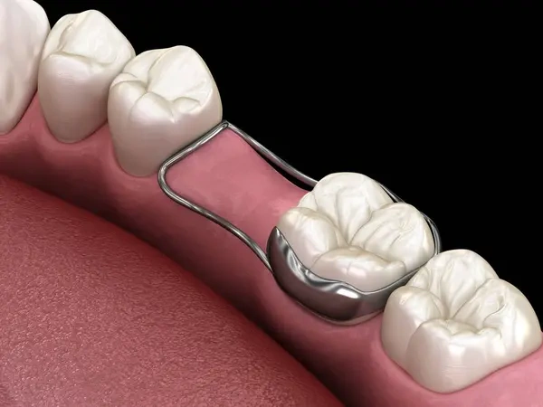 3D dental render showing a unilateral band-and-loop space maintainer holding the gap open after a missing molar tooth.