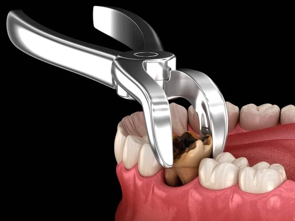 3D dental render showing surgical forceps extracting a severely broken molar tooth ruined by deep dental caries.