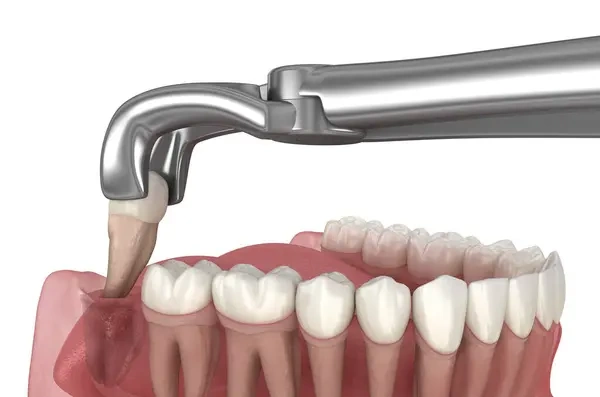 3D dental render showing surgical forceps removing an impacted wisdom tooth from the lower jaw socket