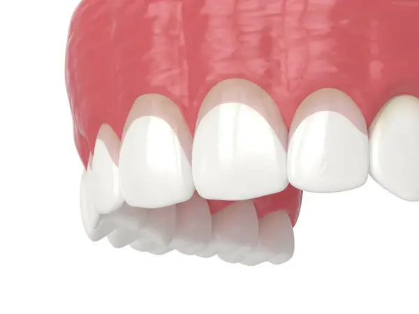 3D dental render showing the final result of a cosmetic gingivectomy with a corrected, symmetrical upper gum line.