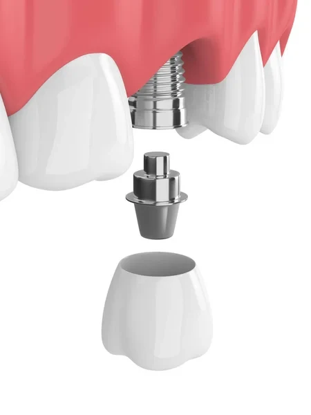 3D diagram showing dental implant parts including the screw, abutment, and crown.