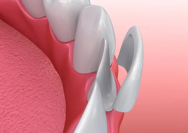 3D illustration showing the procedure for installing a porcelain dental veneer onto a tooth