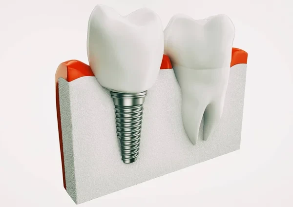 3D medical illustration of a single titanium dental implant structure anchored in the jawbone
