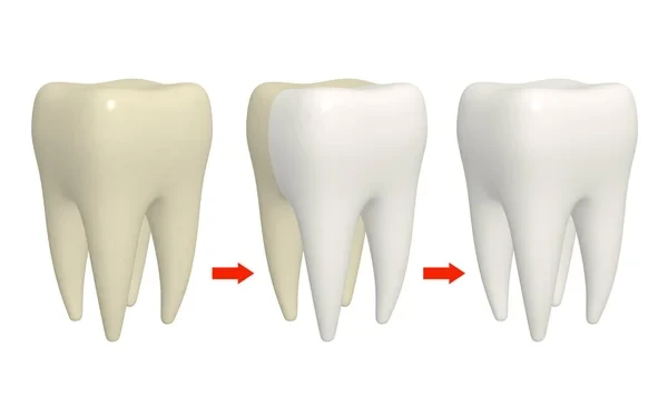 3D medical illustration of a tooth cleaning process showing enamel stain removal
