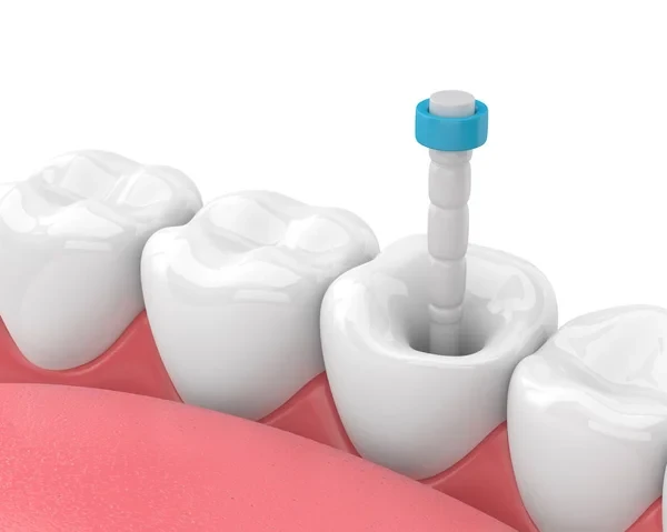 3D medical illustration of endodontic treatment showing a fiber post insertion.