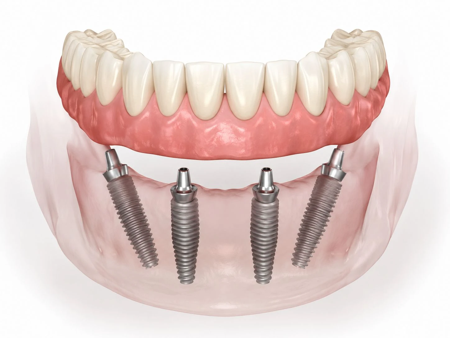 3D rendering of an All-on-4 dental implant system showing a full arch tooth restoration prosthesis