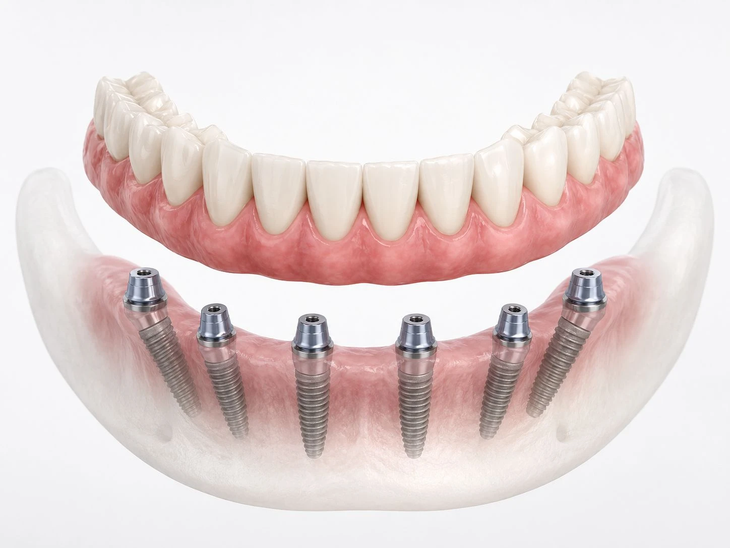 3D rendering of an All-on-6 dental implant system showing a full-arch prosthetic bridge above six titanium posts.
