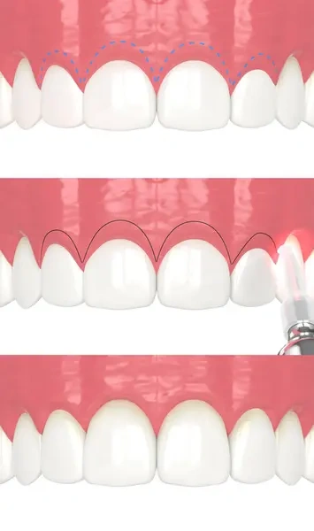 Three-step 3D diagram showing laser gum contouring treatment to correct a gummy smile and reshape the upper gum line