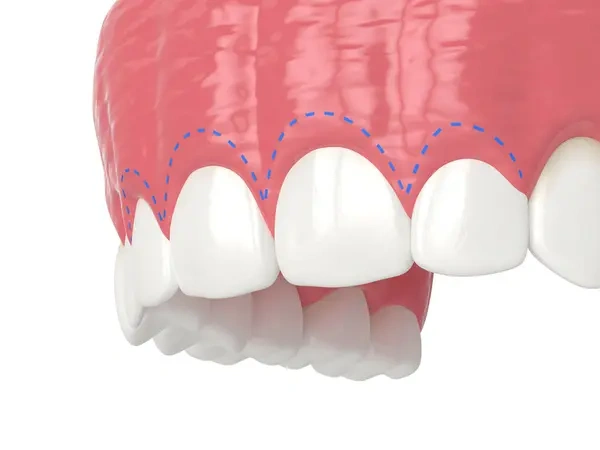 3D dental render showing the planned incision line for a laser gum lift to correct a gummy smile