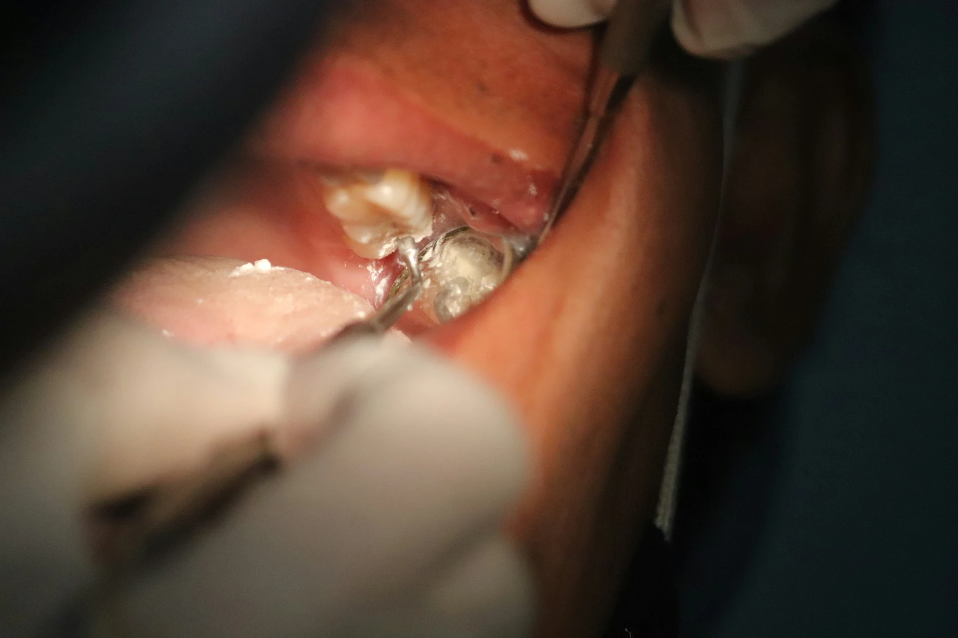 A close-up look of a dentist filling the decayed portion of a tooth