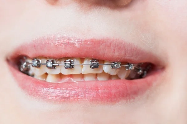 A close-up smile showing silver self-ligating brackets and archwire on the upper teeth