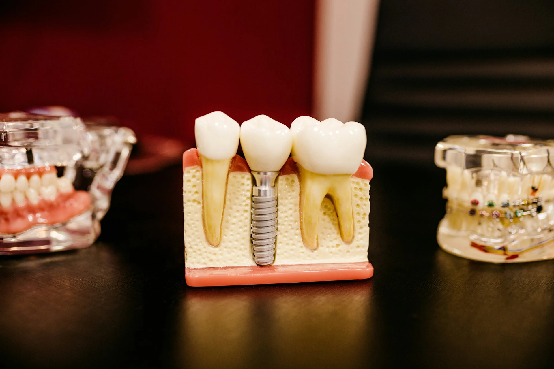 A cross-section dental model demonstrating a single tooth dental implant structure between natural teeth.
