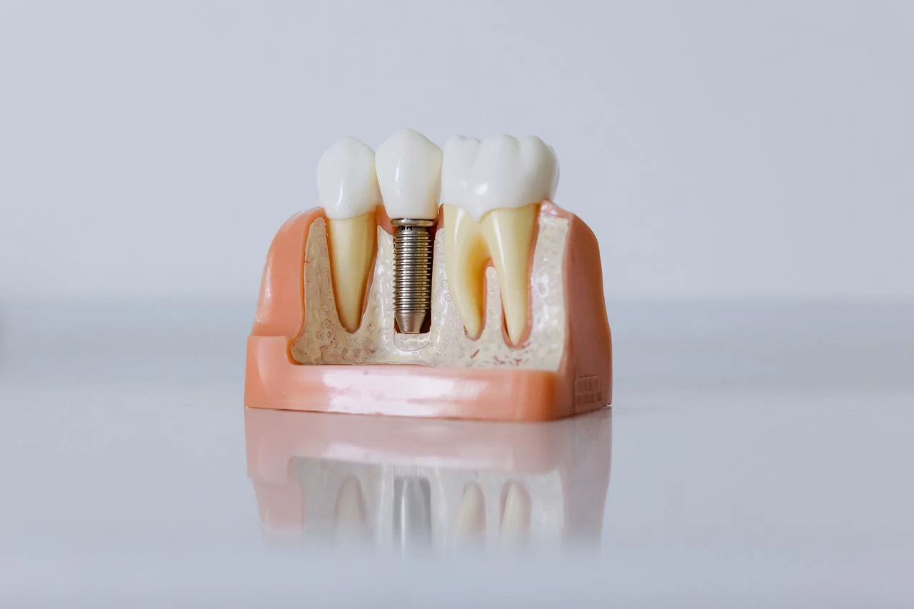A cross-section dental model showing a fully assembled single tooth dental implant between natural teeth.