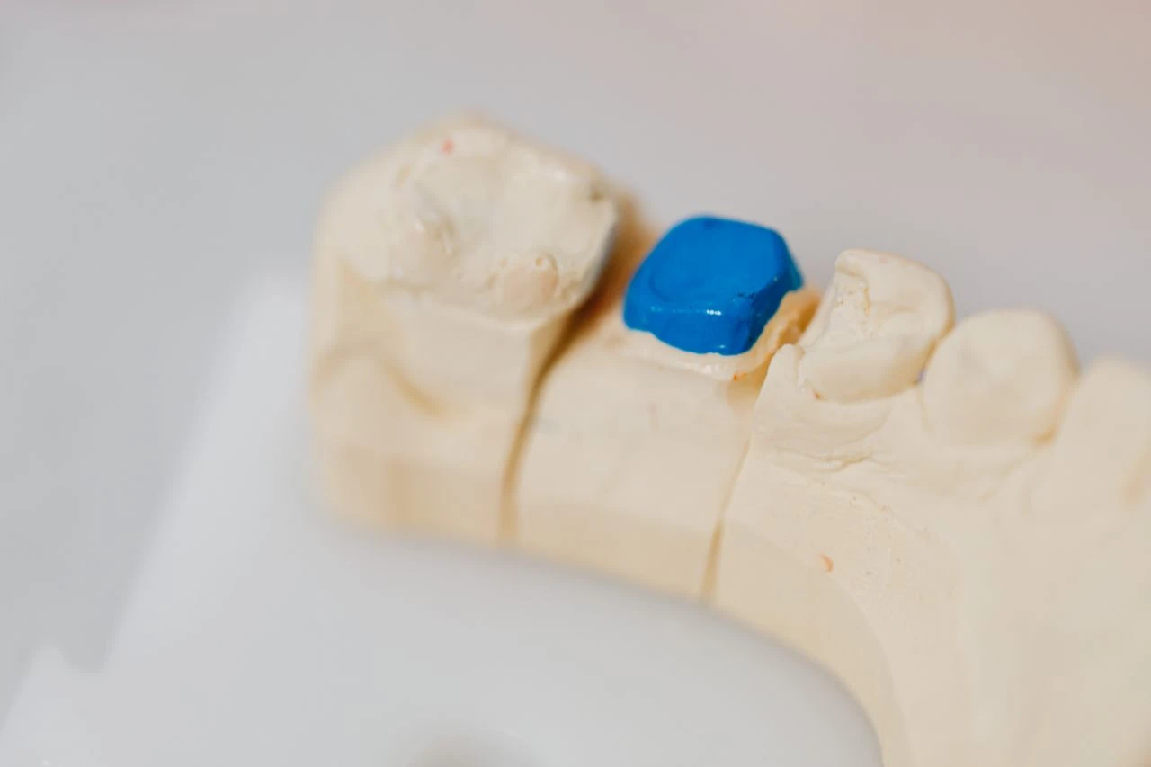A dental cast showcasing a missing tooth along with other teeth