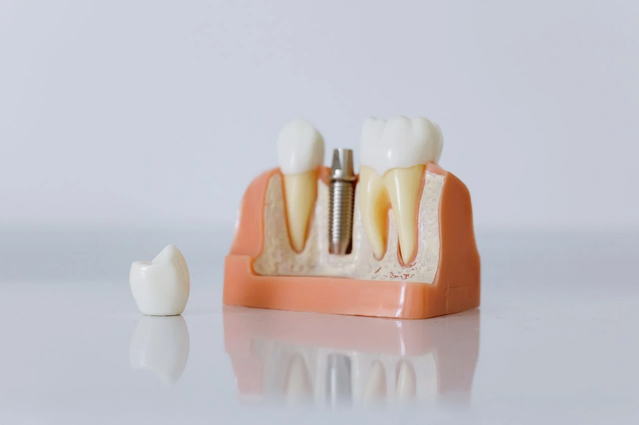 A dental cross-section model showing an implant post with the crown detached to the side.