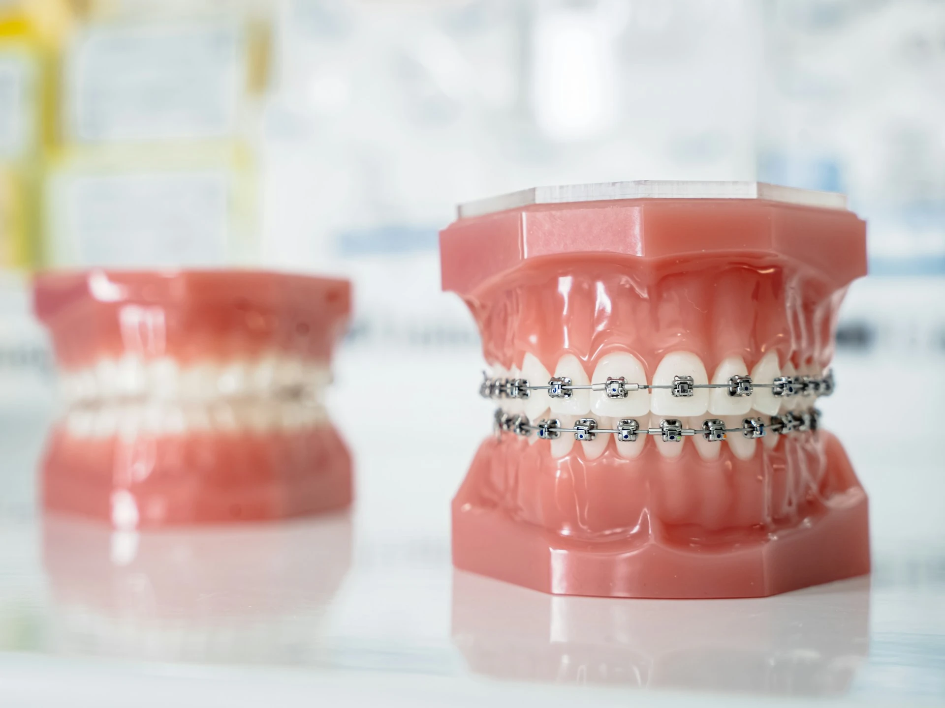 A dental jaw model displaying traditional metal brackets and archwires for orthodontic braces