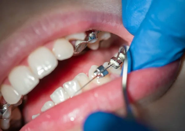 A dentist adjusting silver orthodontic braces on a patient's lower teeth at a dental clinic