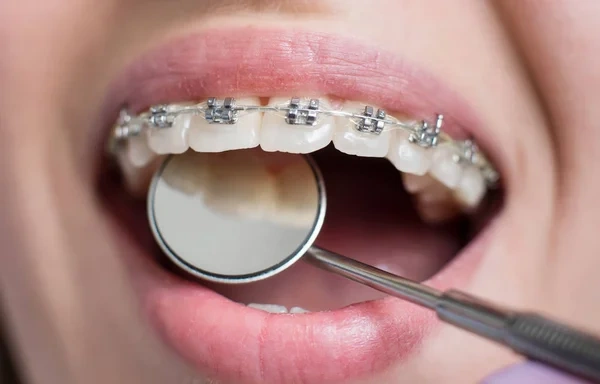 A dentist holding a dental mirror to check a patient's upper teeth with self-ligating metal braces