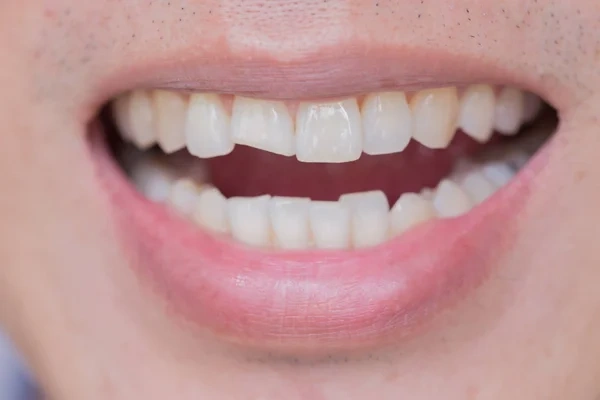 A male smile showing a significantly broken permanent front tooth from a dental injury
