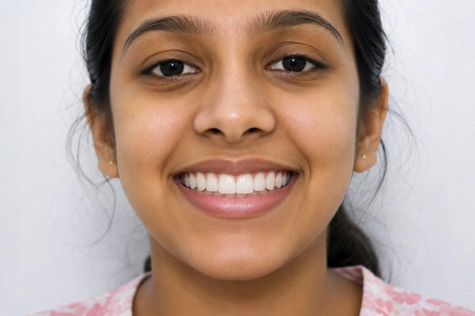 A patient smiling confidently with perfectly aligned teeth following braces removal.