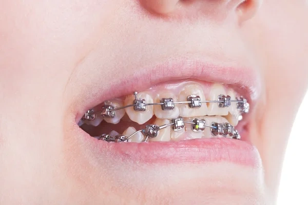 A patient's smile during orthodontic treatment with silver self-ligating dental brackets.