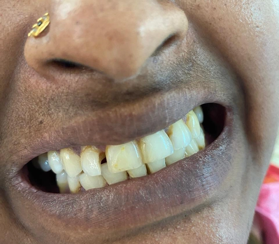 A woman's smile with an uneven and slightly chipped front tooth before dental recontouring