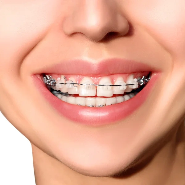 Beautiful woman smiling. Closeup ceramic braces on teeth