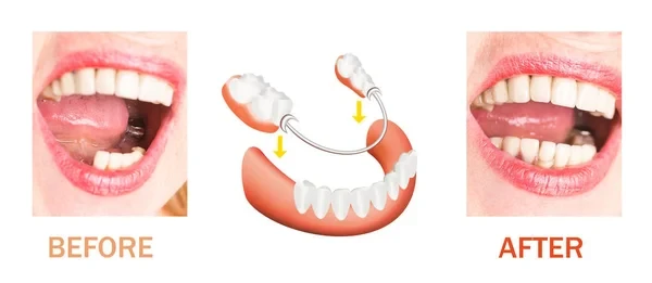 Before after - Partial denture