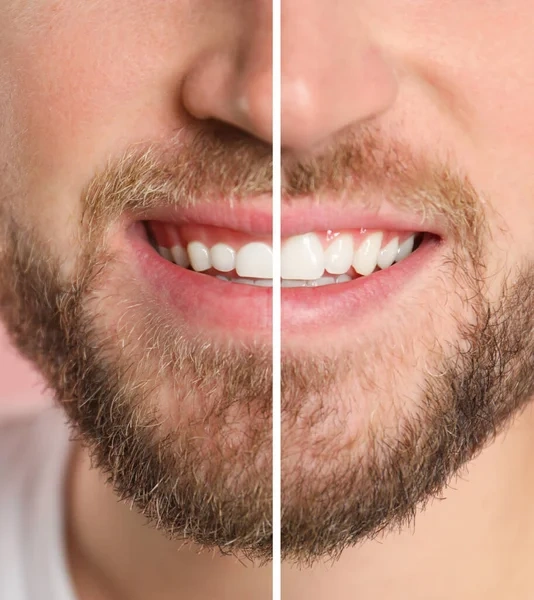 Close-up split image of a young man's smile before a gingivoplasty showing a gummy smile with overgrown gum tissue covering his teeth (left) and after the procedure showing longer teeth and a symmetrical, contoured gumline (right).