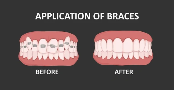 Before and after diagram of orthodontic braces treatment correcting crooked teeth.