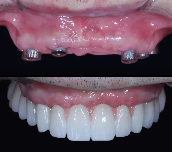 Before and after of an aesthetic full arch dental implant-supported prosthesis smile makeover.