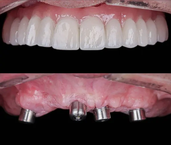 Before and after view of an All-on-4 full-arch dental implant reconstruction, showing titanium multi-unit abutments on the bottom and the final fixed implant-supported bridge on top.