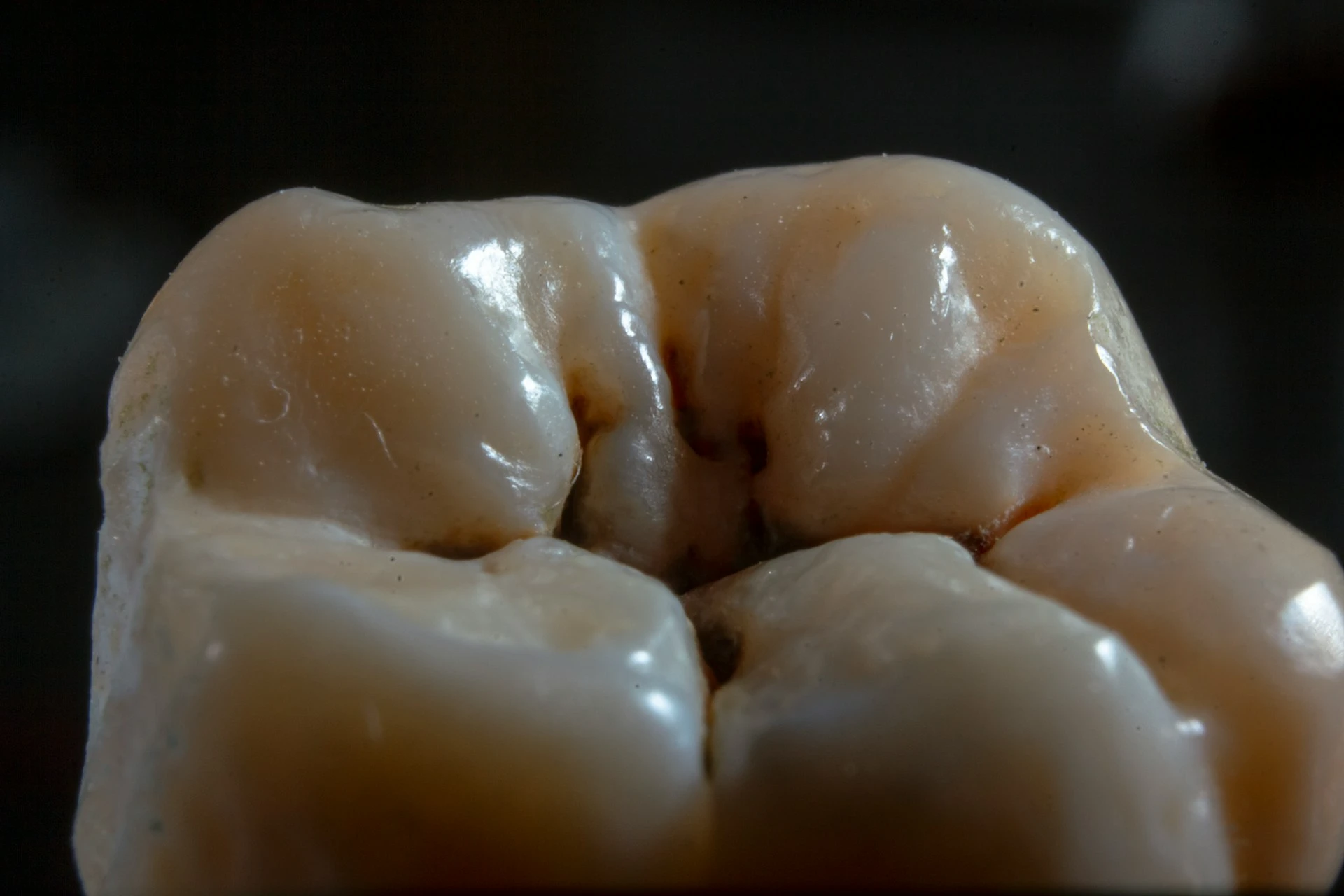 Caries in a tooth