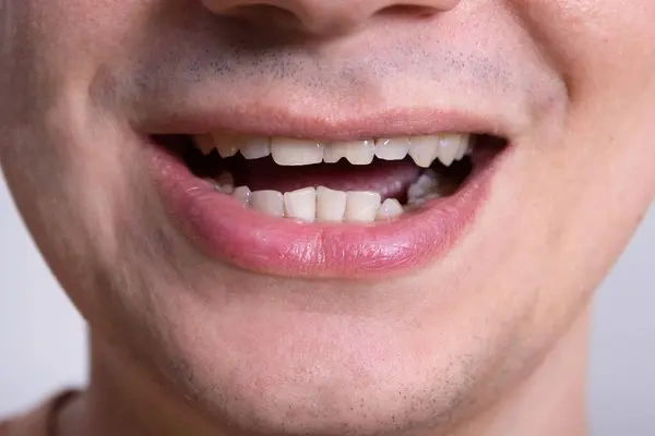 Chipped and jagged front tooth needing minor shape correction and cosmetic dental recontouring