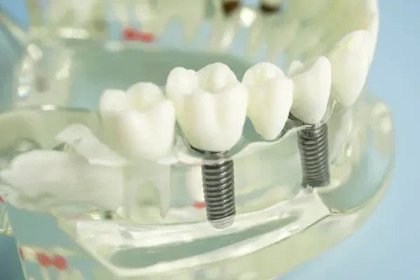 Clear dental model showing an implant-supported bridge resting on two titanium implant screws.