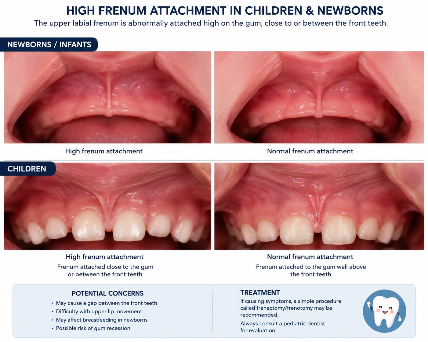 Informational medical chart comparing high versus normal maxillary labial frenum attachments in newborns and infants (top row) alongside a comparison of high and normal frenum attachments causing a front tooth gap in children (bottom row).