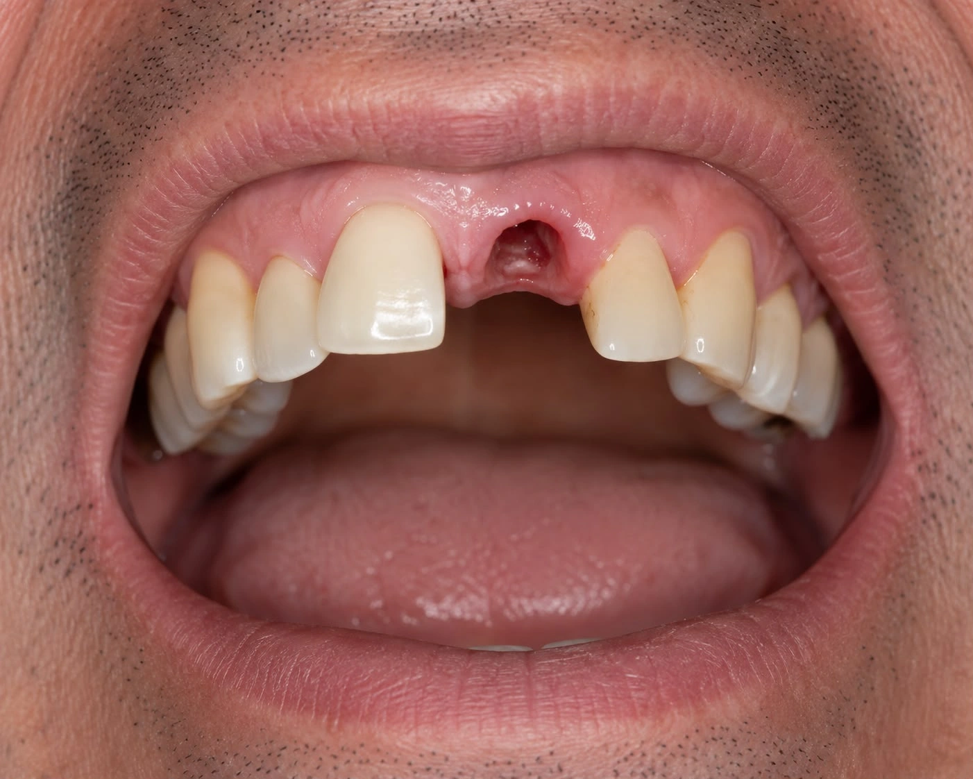 Close-up view of an open mouth showing a missing upper left central incisor tooth with a fresh extraction socket in the pink gum tissue needing a bone grafting procedure.