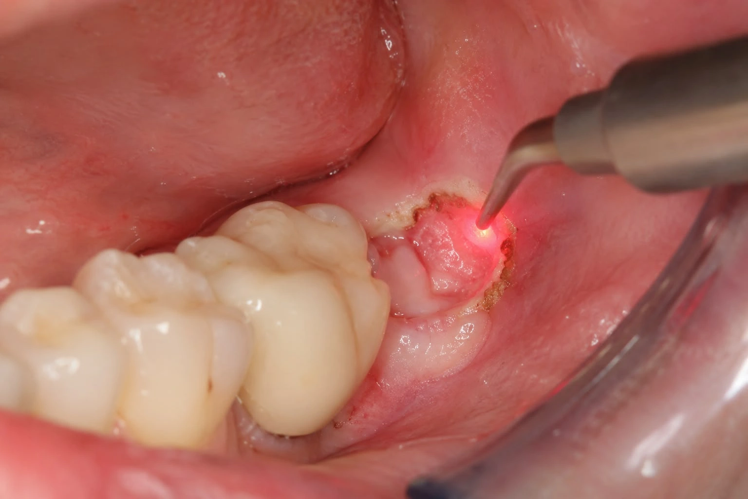 Close-up clinical image of a dental laser tool emitting a precise red light beam onto inflamed gum tissue behind a lower molar tooth during a laser gum treatment procedure.