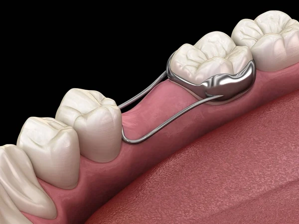 Close-up 3D model showing a fixed orthodontic space maintainer loop resting against an adjacent tooth.