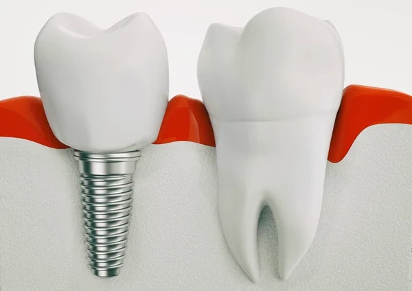Close-up 3D rendering comparing a single titanium dental implant with a natural tooth root in the jawbone.