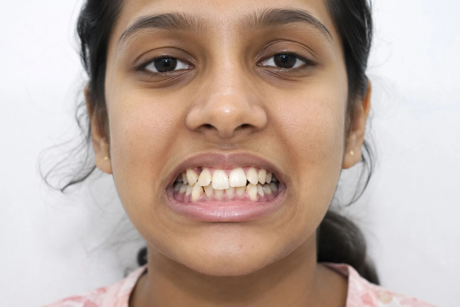 Dental patient showing teeth crowding and misalignment prior to getting braces.