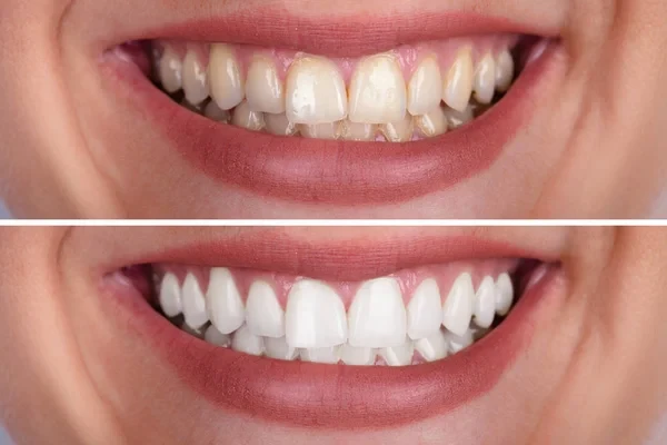 Close-up of a smiling woman's teeth before and after whitening