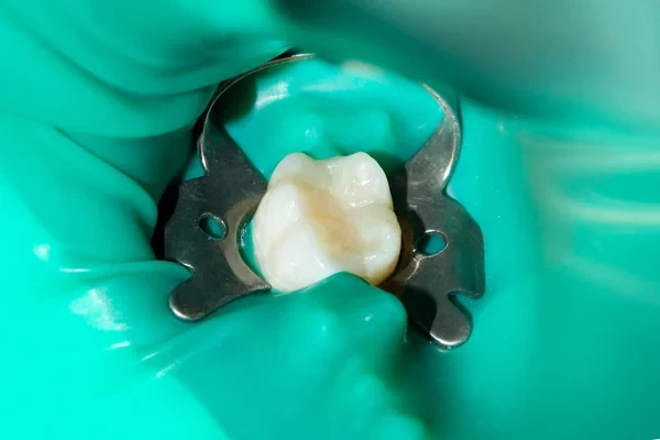 Close-up of a tooth after RCT